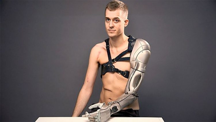 prosthetic-arm